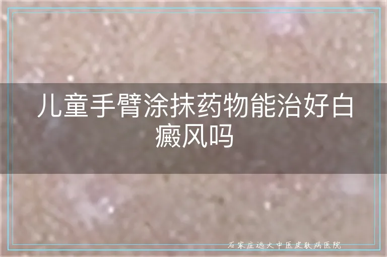 儿童手臂涂抹药物能治好白癜风吗