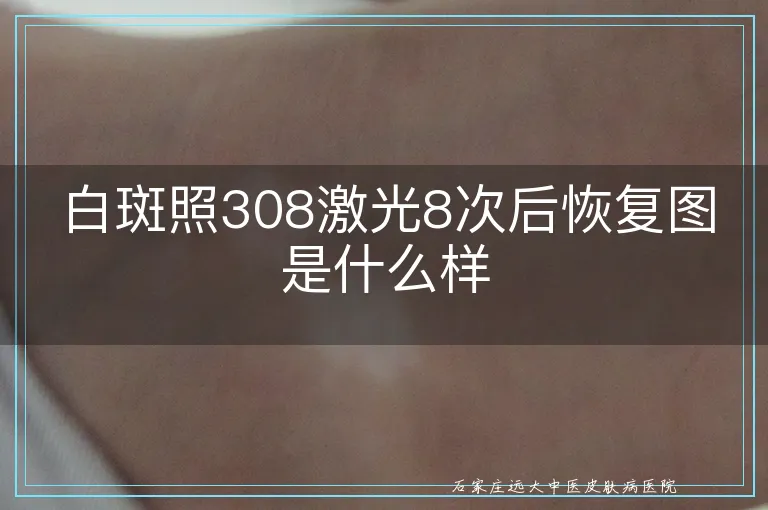 白斑照308激光8次后恢复图是什么样