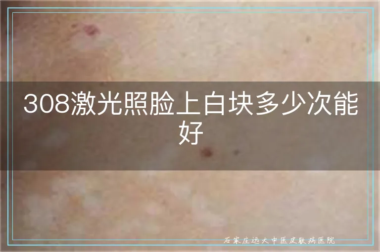 308激光照脸上白块多少次能好