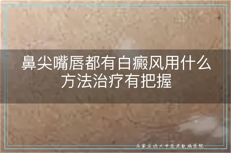 鼻尖嘴唇都有白癜风用什么方法治疗有把握