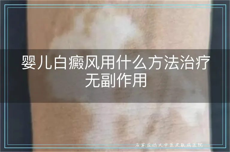 婴儿白癜风用什么方法治疗无副作用