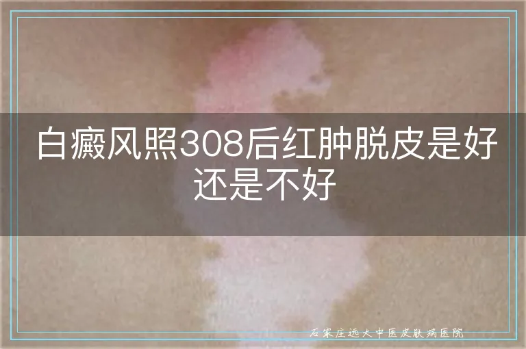 白癜风照308后红肿脱皮是好还是不好