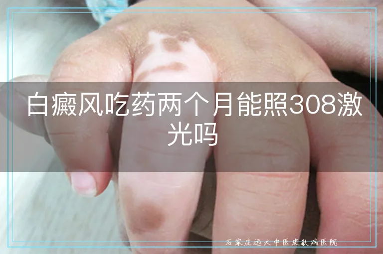 白癜风吃药两个月能照308激光吗