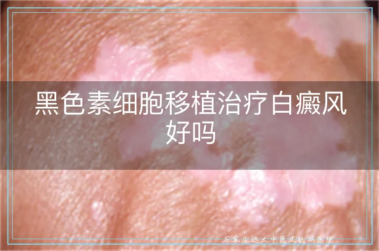 黑色素细胞移植治疗白癜风好吗