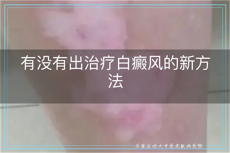 有没有出治疗白癜风的新方法