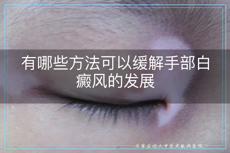 有哪些方法可以缓解手部白癜风的发展