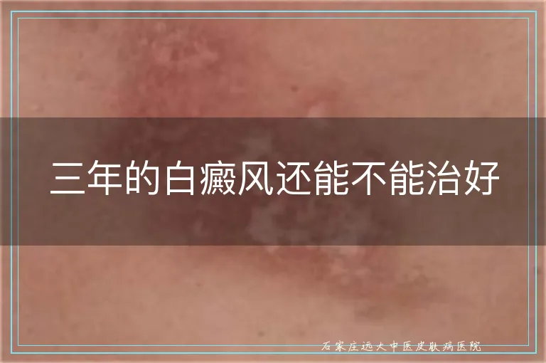 三年的白癜风还能不能治好