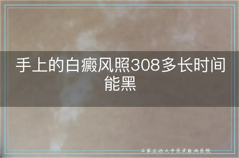 手上的白癜风照308多长时间能黑