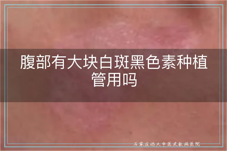 腹部有大块白斑黑色素种植管用吗