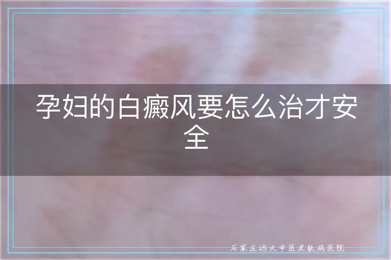 孕妇的白癜风要怎么治才安全