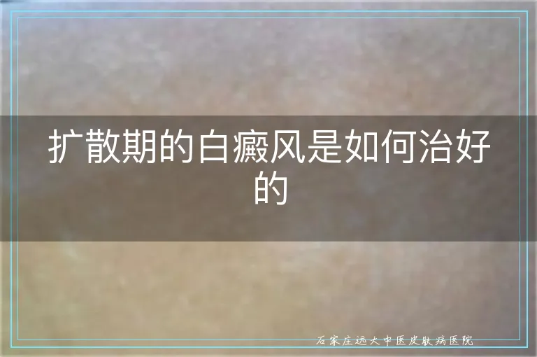 扩散期的白癜风是如何治好的
