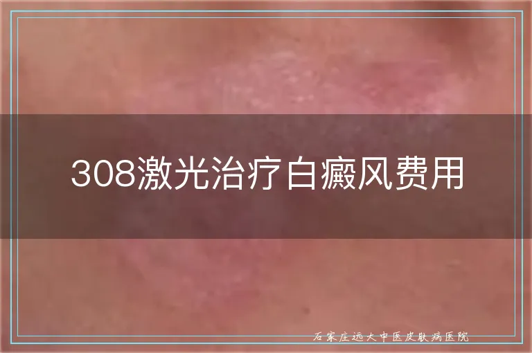 308激光治疗白癜风费用