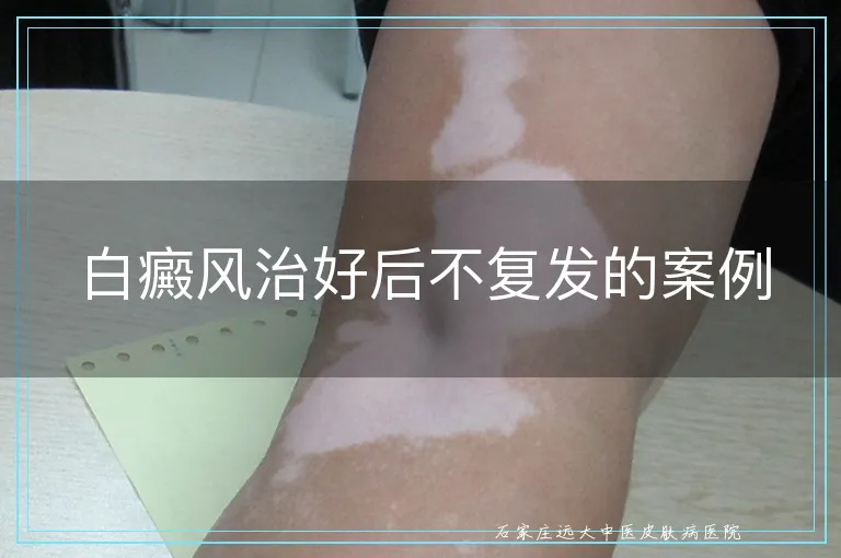 白癜风治好后不复发的案例