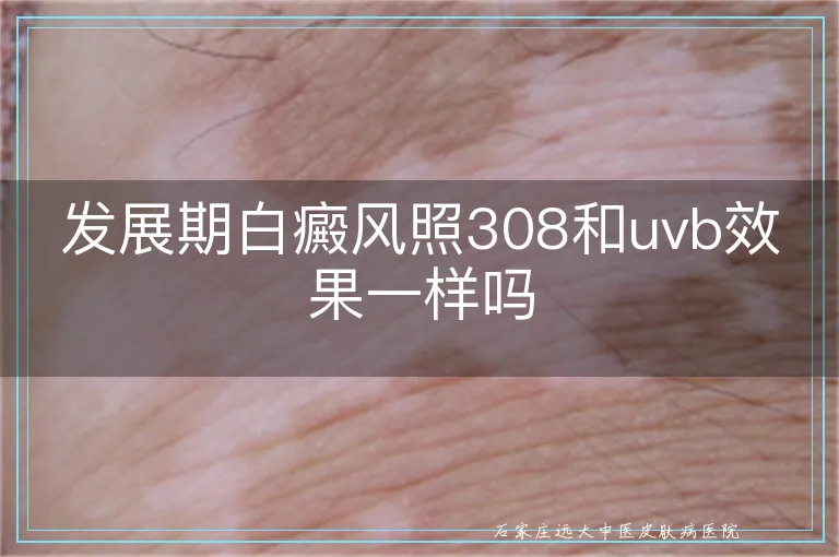 发展期白癜风照308和uvb效果一样吗