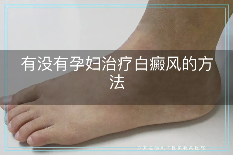 有没有孕妇治疗白癜风的方法