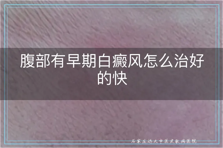 腹部有早期白癜风怎么治好的快
