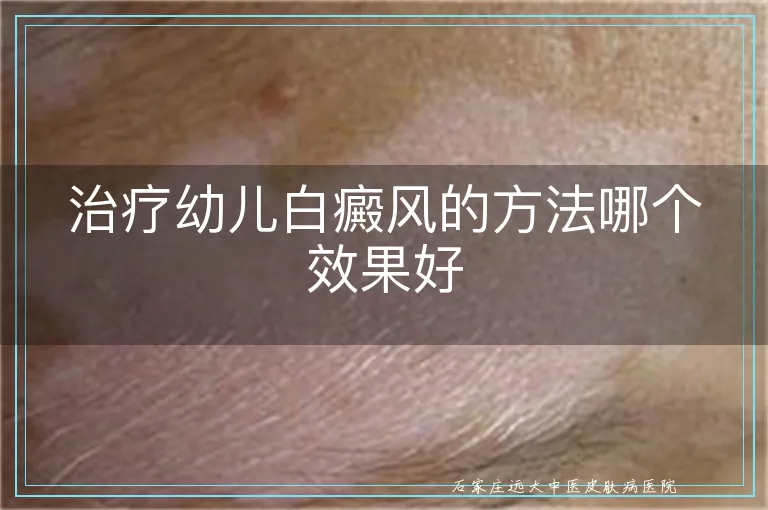 治疗幼儿白癜风的方法哪个效果好