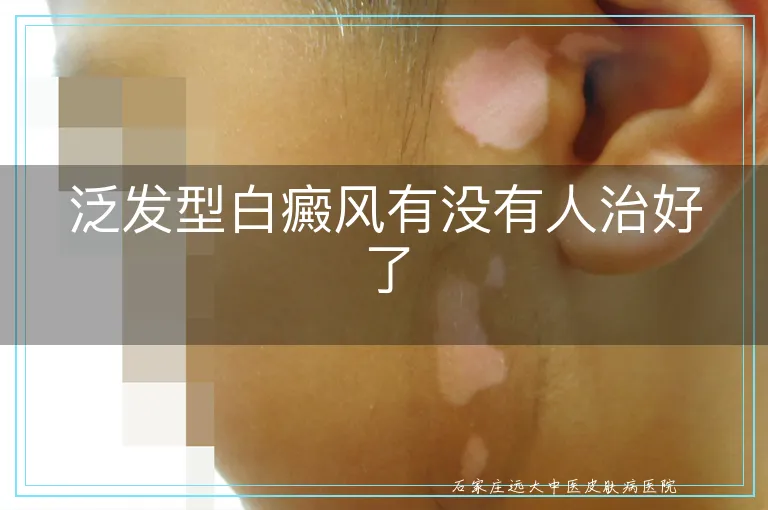 泛发型白癜风有没有人治好了
