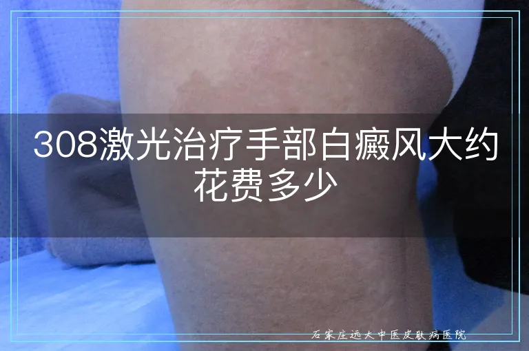308激光治疗手部白癜风大约花费多少