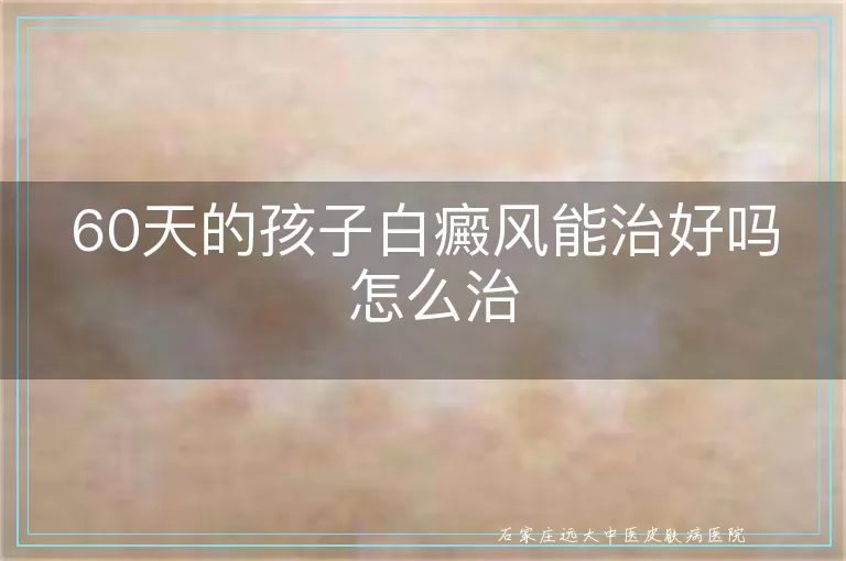 60天的孩子白癜风能治好吗 怎么治