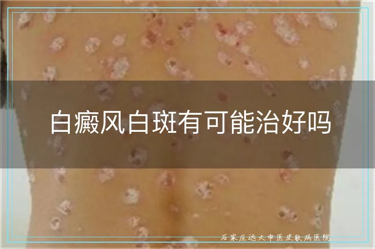 白癜风白斑有可能治好吗