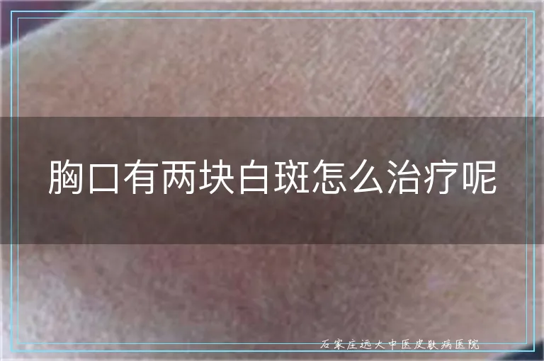 胸口有两块白斑怎么治疗呢
