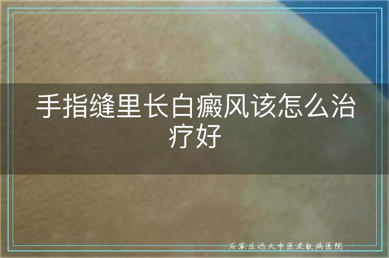 手指缝里长白癜风该怎么治疗好