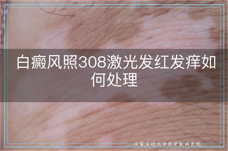 白癜风照308激光发红发痒如何处理