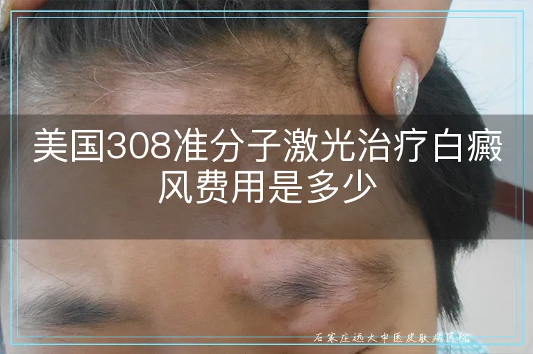 美国308准分子激光治疗白癜风费用是多少