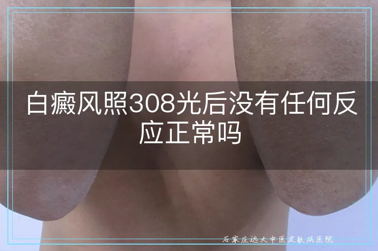 白癜风照308光后没有任何反应正常吗