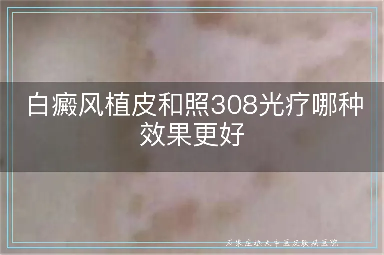 白癜风植皮和照308光疗哪种效果更好