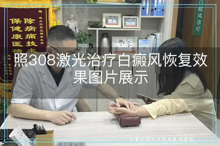 照308激光治疗白癜风恢复效果图片展示