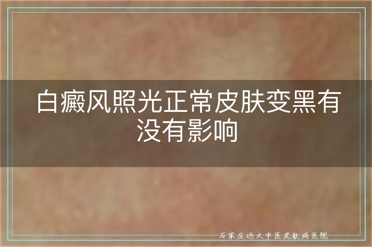 白癜风照光正常皮肤变黑有没有影响