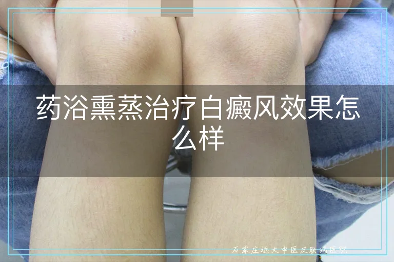 药浴熏蒸治疗白癜风效果怎么样