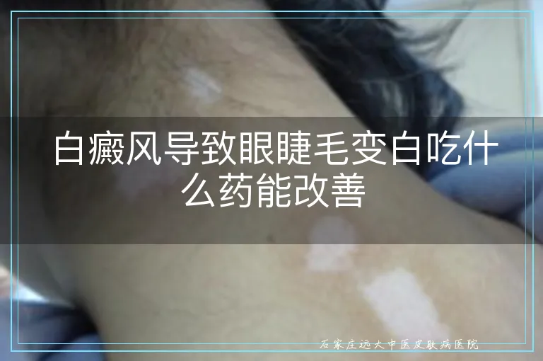 白癜风导致眼睫毛变白吃什么药能改善