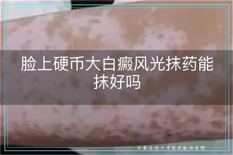 脸上硬币大白癜风光抹药能抹好吗