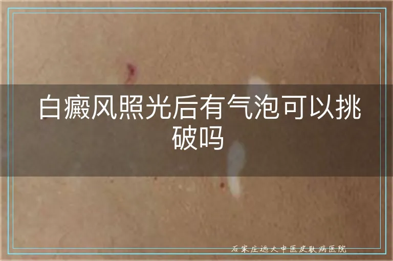 白癜风照光后有气泡可以挑破吗