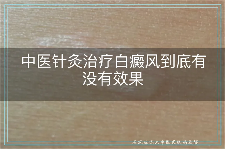 中医针灸治疗白癜风到底有没有效果