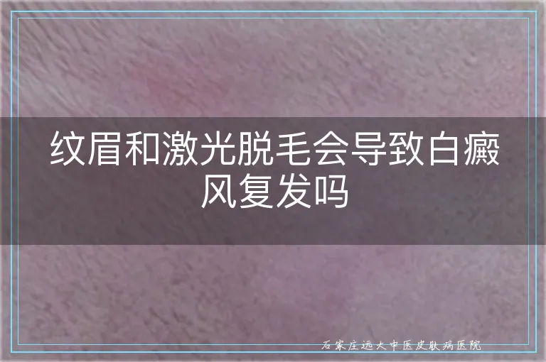 纹眉和激光脱毛会导致白癜风复发吗
