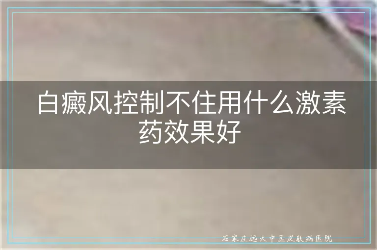 白癜风控制不住用什么激素药效果好