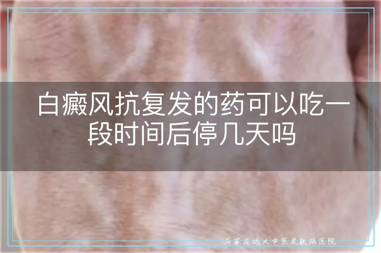 白癜风抗复发的药可以吃一段时间后停几天吗
