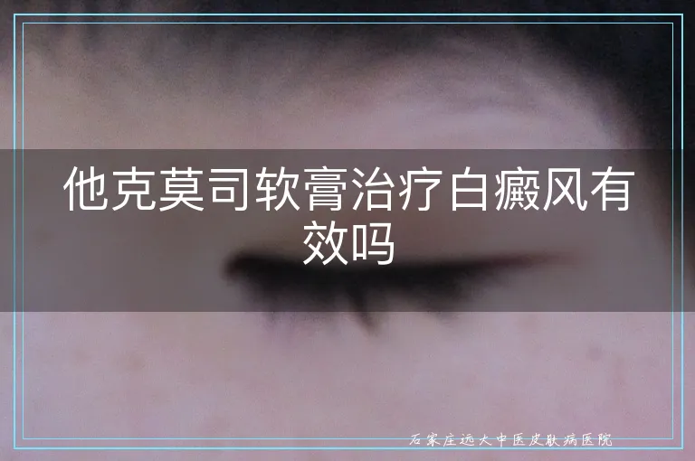 他克莫司软膏治疗白癜风有效吗