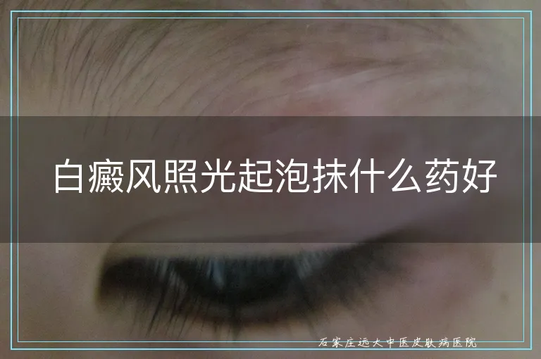 白癜风照光起泡抹什么药好