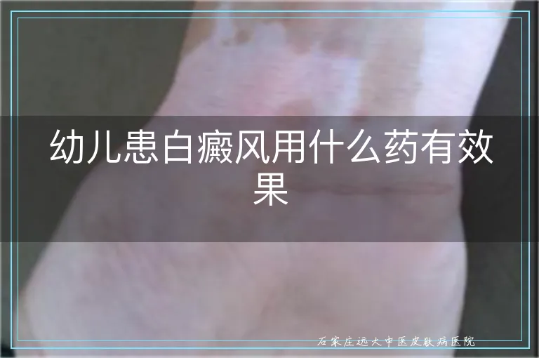 幼儿患白癜风用什么药有效果
