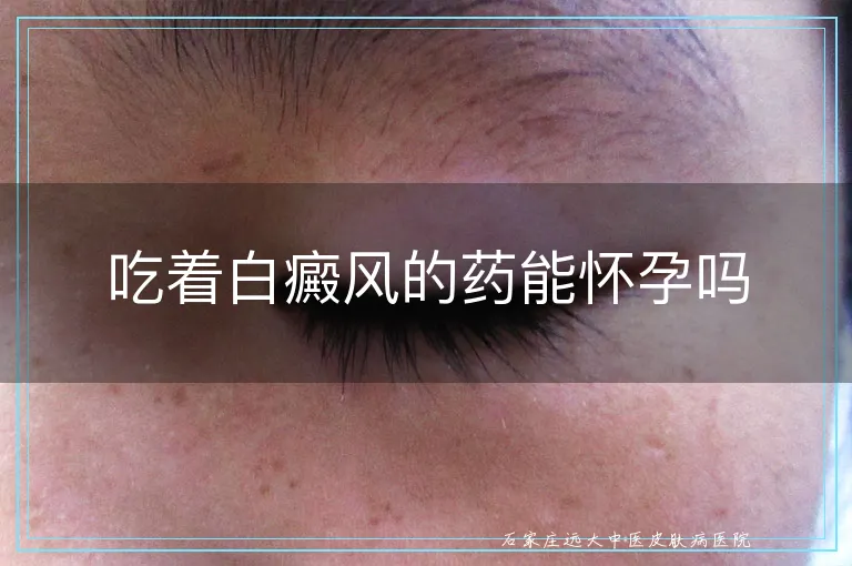 吃着白癜风的药能怀孕吗