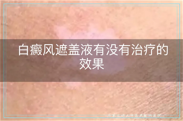 白癜风遮盖液有没有治疗的效果