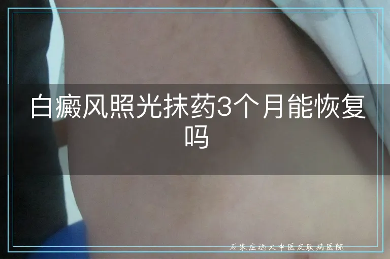 白癜风照光抹药3个月能恢复吗
