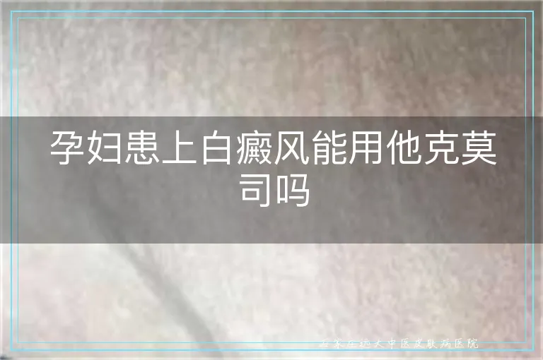 孕妇患上白癜风能用他克莫司吗