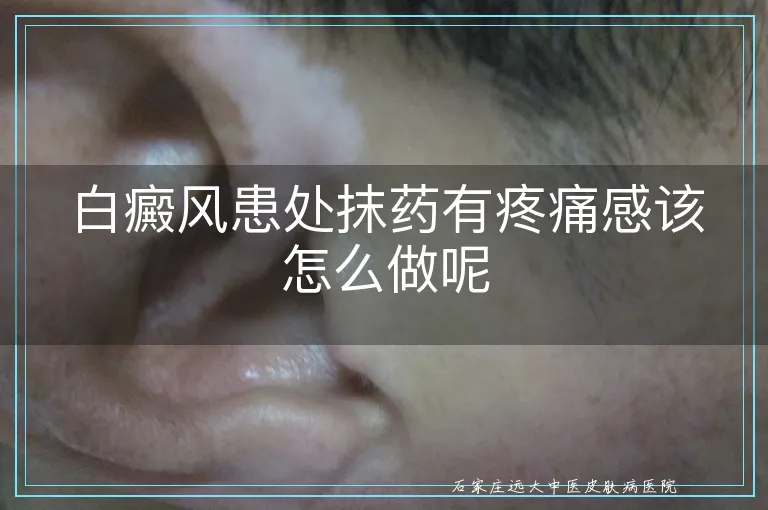 白癜风患处抹药有疼痛感该怎么做呢
