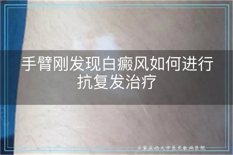 手臂刚发现白癜风如何进行抗复发治疗
